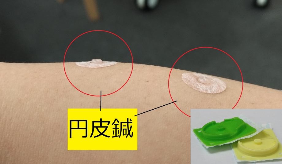 円皮鍼はじめました 治療効果を継続させるのにおすすめです ひれがさき整骨院